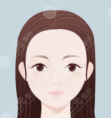 怎樣防止魚尾紋及保養(yǎng)方法，分為醫(yī)美和非醫(yī)美兩種方案！