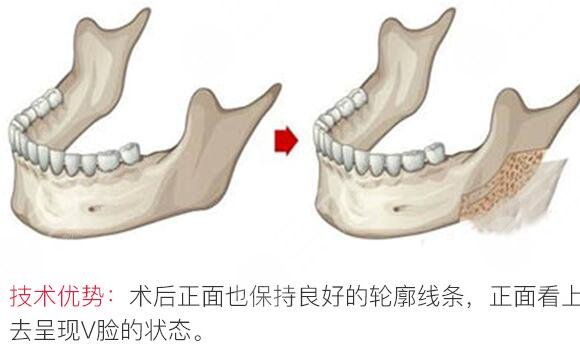 削骨手術(shù)一般要多少錢？2023價格參考！正規(guī)醫(yī)院3家可選~