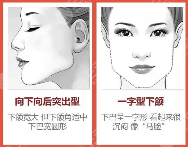 削骨手術(shù)一般要多少錢？