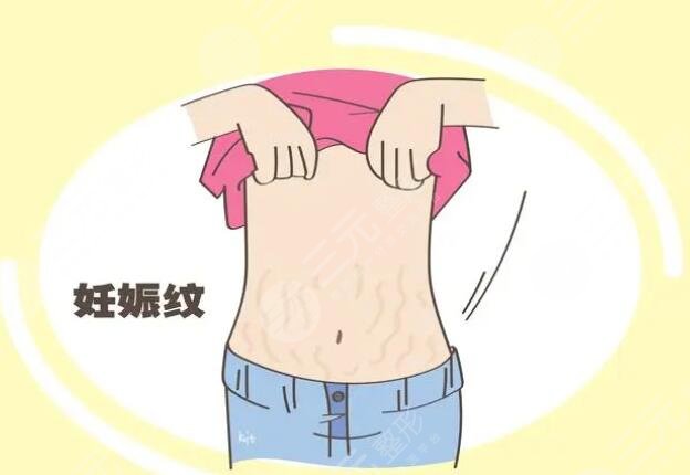 橄欖油去除妊娠紋需要配合使用身體乳嘛？使用方法