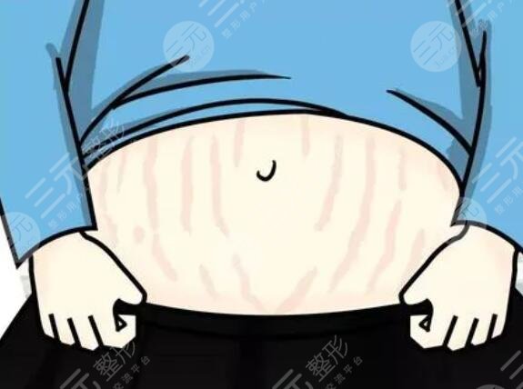 5個妙招幫助消除妊娠紋