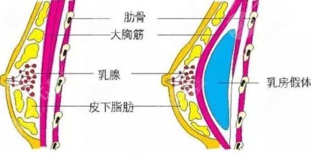 娜綺麗假體隆胸