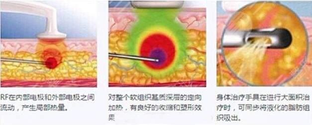 光纖溶脂優(yōu)勢(shì)：