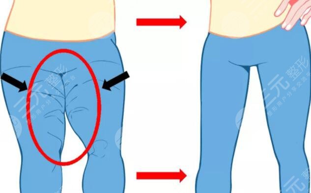 光纖溶脂術(shù)后護(hù)理方法有哪些?