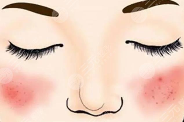 紅血絲激光多少錢