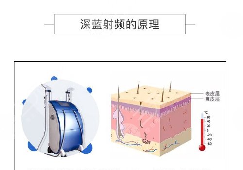 深藍(lán)射頻間隔多久做一次？