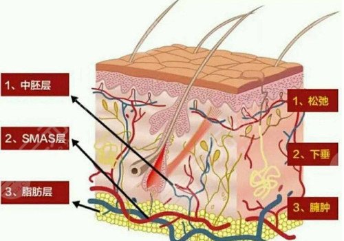 深藍射頻和熱拉提的區(qū)別