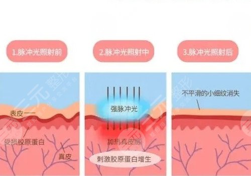 深藍射頻和熱拉提的區(qū)別
