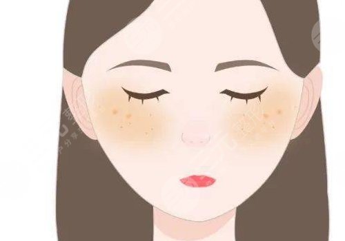 激光祛斑會(huì)不會(huì)反彈？