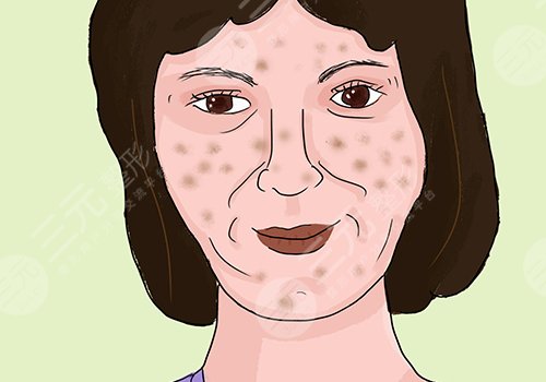 激光祛斑會(huì)不會(huì)反彈？