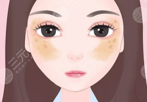 激光祛斑會(huì)不會(huì)反彈？