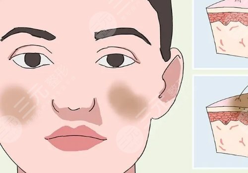 激光祛斑會(huì)不會(huì)反彈？