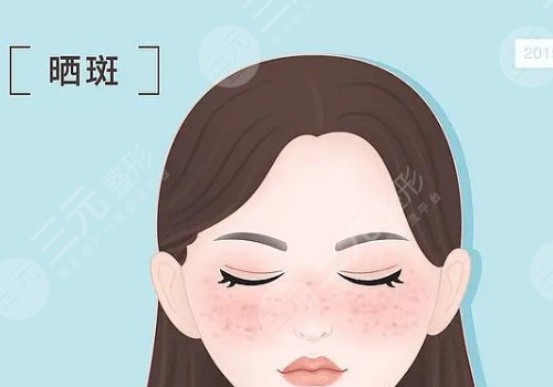 曬斑如何淡化或去掉？