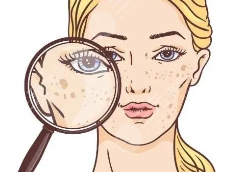 曬斑如何淡化或去掉？