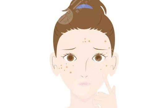 曬斑如何淡化或去掉？