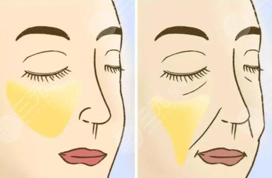 面部下垂整形手術(shù)費(fèi)用大概多少2023？為何價(jià)格有高有低？影響因素是啥？