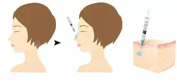 玻尿酸隆鼻有副作用和危害嗎?