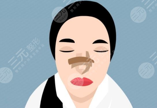 自體軟骨隆鼻好嗎有效果嗎？材料優(yōu)勢/價(jià)格多少錢/注意事項(xiàng)