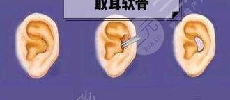 自體軟骨隆鼻好嗎有效果嗎?