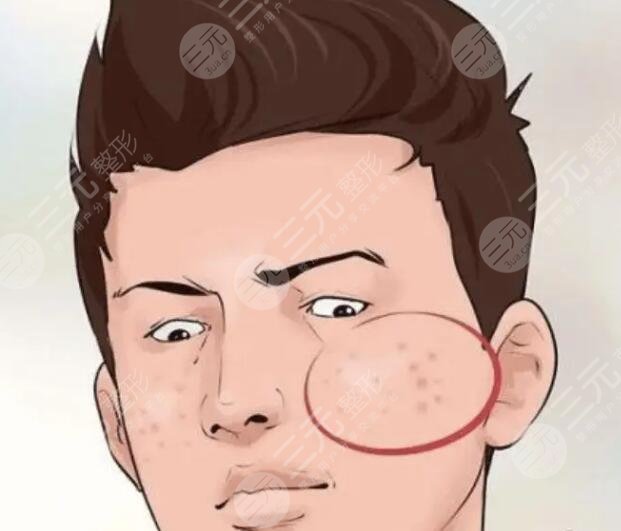 男生去痘印選哪種護膚品好?