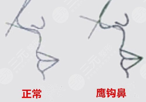 海鷗線和鷹鉤鼻的區(qū)別