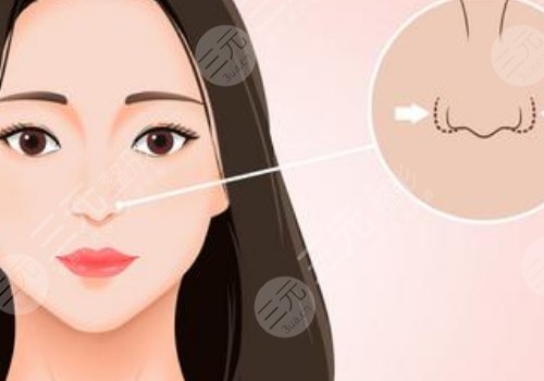 海鷗線和鷹鉤鼻的區(qū)別