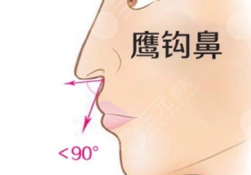 海鷗線和鷹鉤鼻的區(qū)別