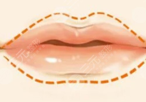 唇部注射玻尿酸會(huì)栓塞嗎？