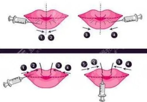 唇部注射玻尿酸多久可以恢復(fù)？