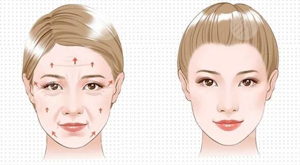 冰電波拉皮除皺的效果怎么樣?