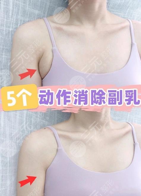 腋下副乳運動消除方法