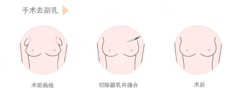 腋下副乳運動消除方法