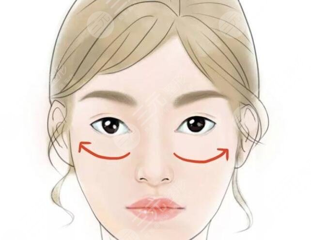 蘋(píng)果肌復(fù)位