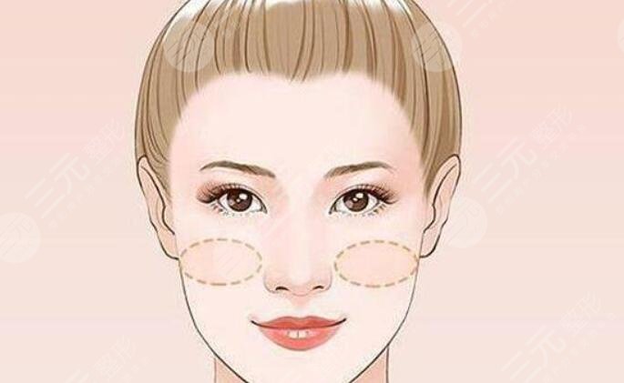 蘋(píng)果肌復(fù)位