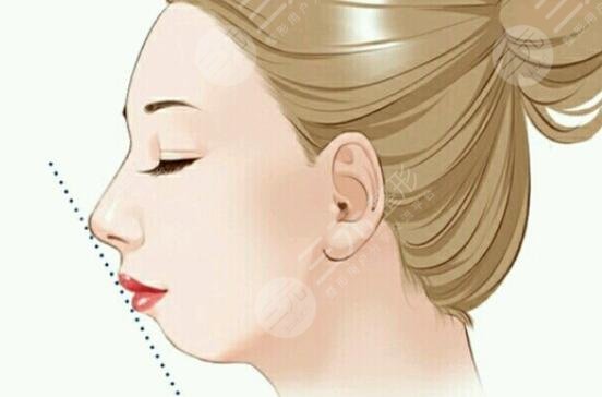 下頜角內(nèi)收