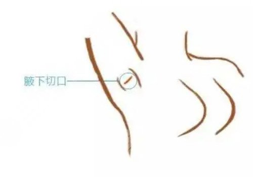 隆胸腋下切口的優(yōu)勢(shì)和缺點(diǎn)有哪些？