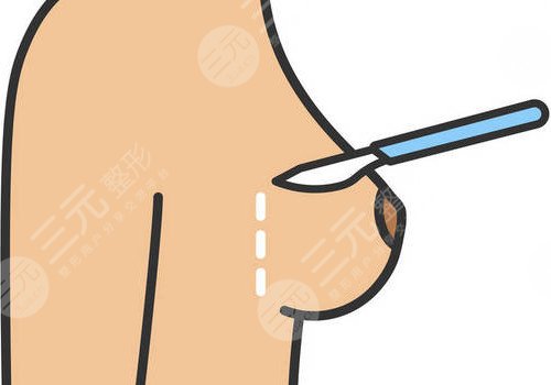 隆胸腋下切口的優(yōu)勢(shì)和缺點(diǎn)有哪些？