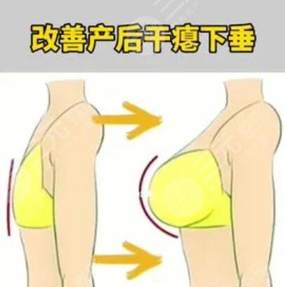 假體隆胸手術(shù)哪種材料好?