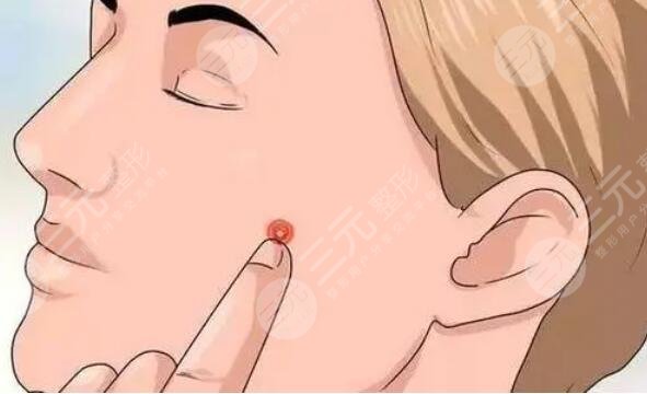 激光磨皮去痘印多少錢一般？術(shù)后注意飲食合理搭配，加固效果！