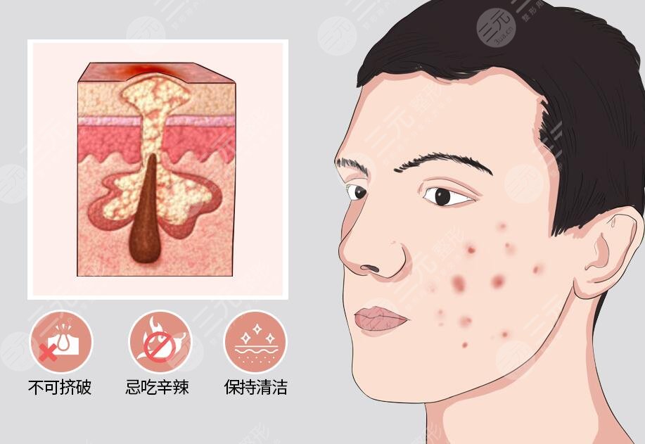 激光去痘印之后應(yīng)該怎樣去護(hù)理?