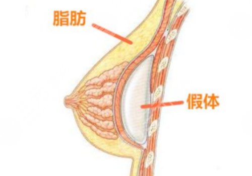 假體豐胸如何避免包膜痙攣？