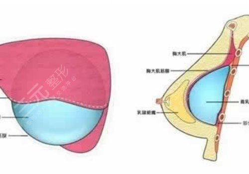 假體豐胸如何避免包膜痙攣？