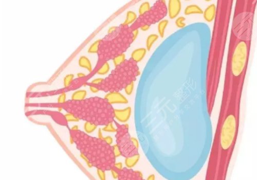 假體豐胸如何避免包膜痙攣？