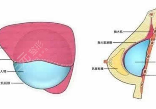 光面假體隆胸后需要怎么樣按摩？