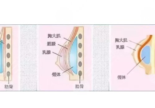 光面假體隆胸后需要怎么樣按摩？