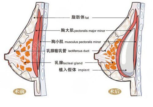 光面假體隆胸后需要怎么樣按摩？