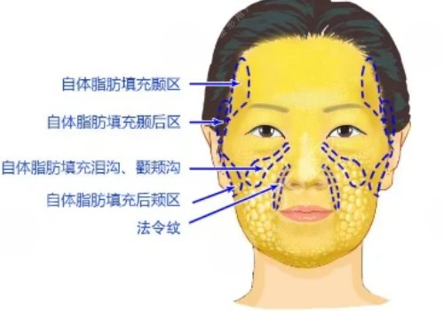面部脂肪填充的好處和壞處有哪些
