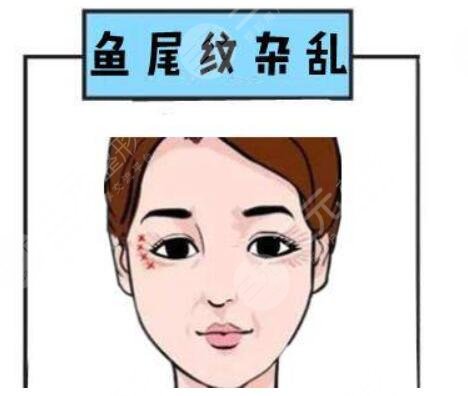 祛除魚尾紋的注意事項