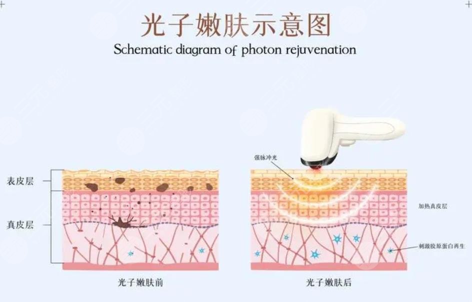 光子嫩膚祛斑效果如何