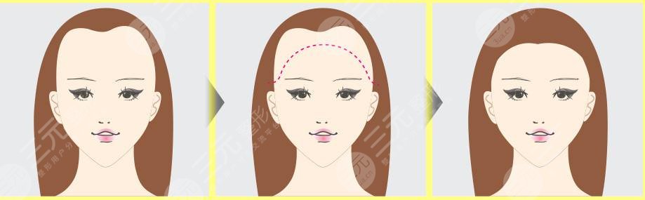 紋發(fā)際線和植發(fā)哪個好？區(qū)別對比分析！術(shù)前必看~